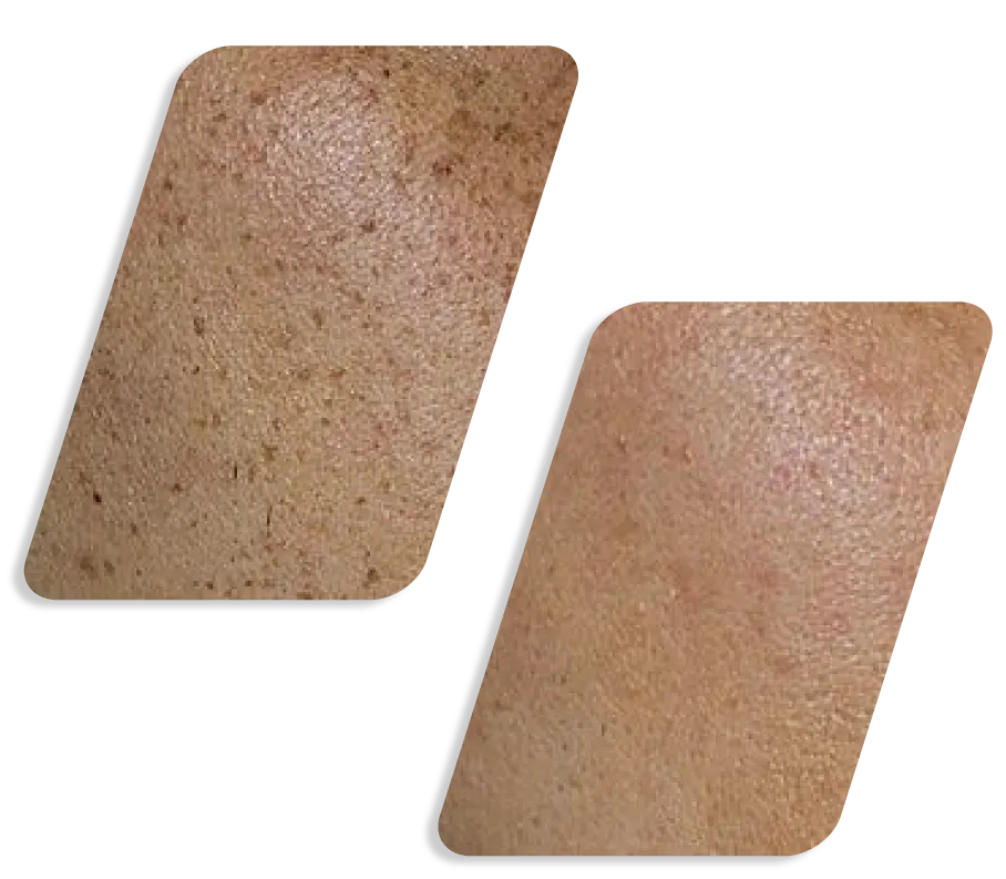 Q Switch Lazer Before After