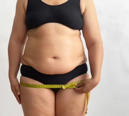 lipodem-ameliyati-riskleri-m Lipödem Ameliyatı Riskleri şişman kadın