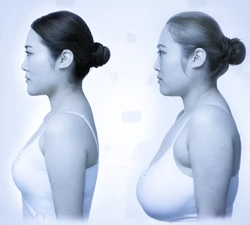 Breast Reduction