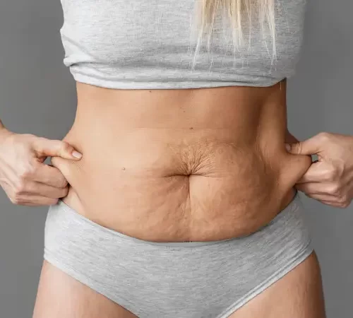 tummy tuck