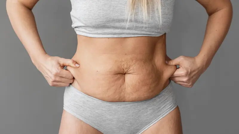 tummy tuck