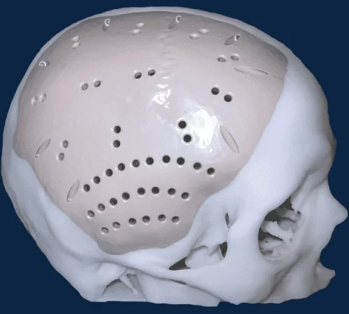 Kranioplasti Nedir?- implant takılmış beyin görseli
