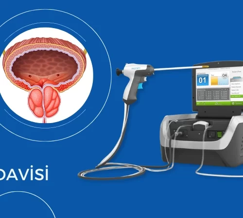 Prostat Büyümesinde Etkili Tedavi: REZUM- prostat cihazı ve prostat