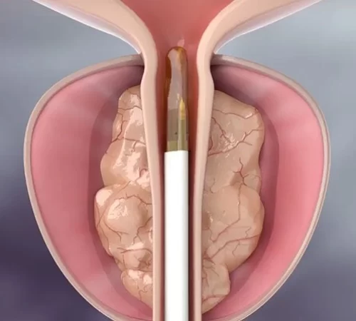 Rezum Tedavisi Yan Etkileri- prostat