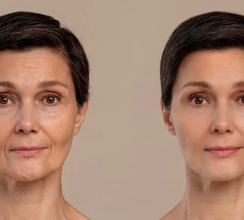 Etkili Anti-Aging Tedavisi : Hydrafacial - cilt bakımı yaptırmış kişinin sonucu