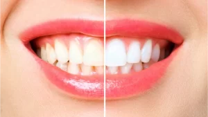 Diş Beyazlatma Nedir? Yöntemleri - yarısına beyazlatma işlemi yapılmış diş