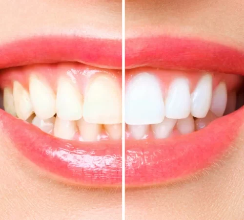 Diş Beyazlatma Nedir? Yöntemleri - yarısına beyazlatma işlemi yapılmış diş