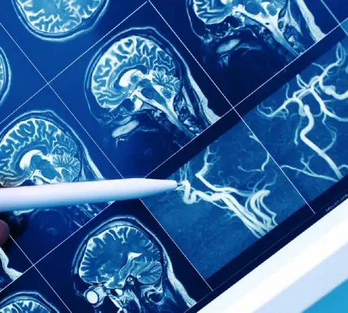 Beyin ve Damar Tıkanıklıkları - beyin ve damar görüntüleri