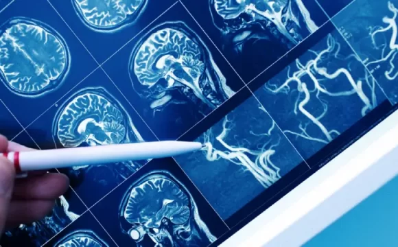 Beyin ve Damar Tıkanıklıkları - beyin ve damar görüntüleri
