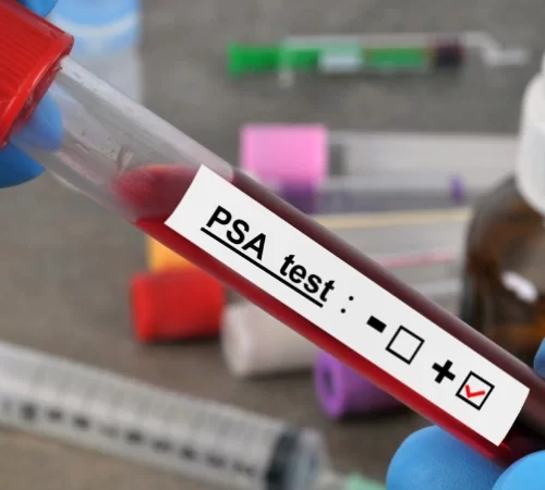 Yaşlara Göre PSA Değerleri - PSA testi