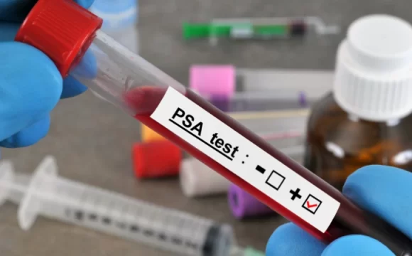 Yaşlara Göre PSA Değerleri - PSA testi
