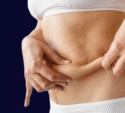 preventing sagging skin after weight loss surgery