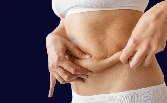 preventing sagging skin after weight loss surgery
