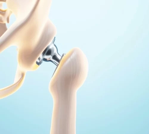 hip replacement in turkey