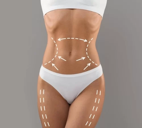 laser liposuction in turkey