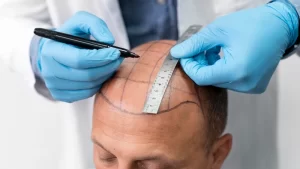 best place for Hair Transplant in Turkey