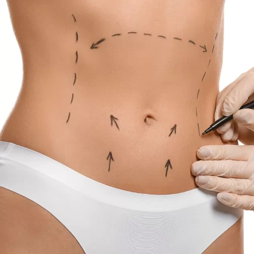 Operația de abdominoplastie