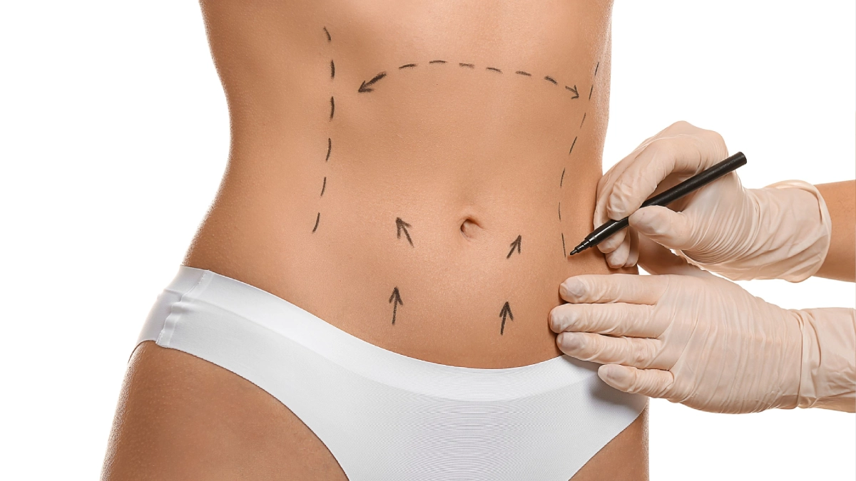 Operația de abdominoplastie