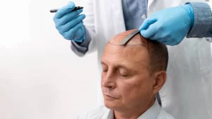 Hair Transplant in Turkey for US Patients