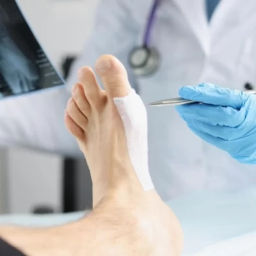 Bunion surgery in turkey