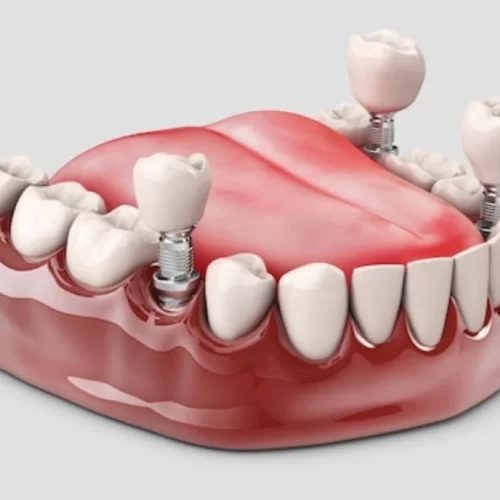 Dental Implants in Istanbul