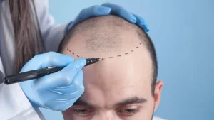 Implantul de păr în Turcia: Procedeul acestuia de la A la Z