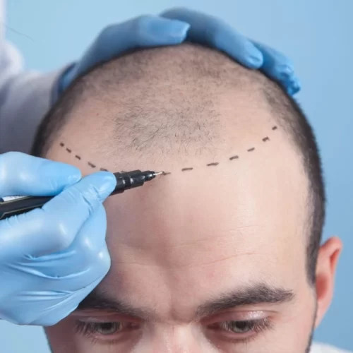 Implantul de păr în Turcia: Procedeul acestuia de la A la Z
