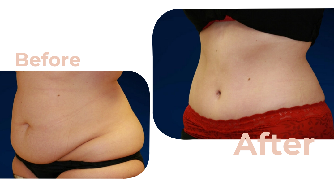 Recent Tummy Tuck before and after - The Avoca Clinic