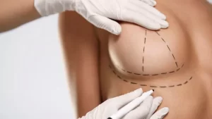 جراحی پروتز سینه در ترکیه