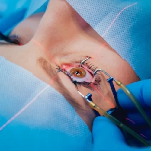 Laser Eye Surgery in Turkey