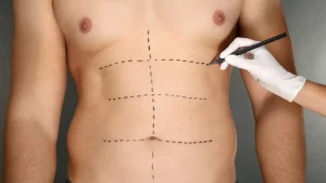 Six Pack Surgery in Turkey