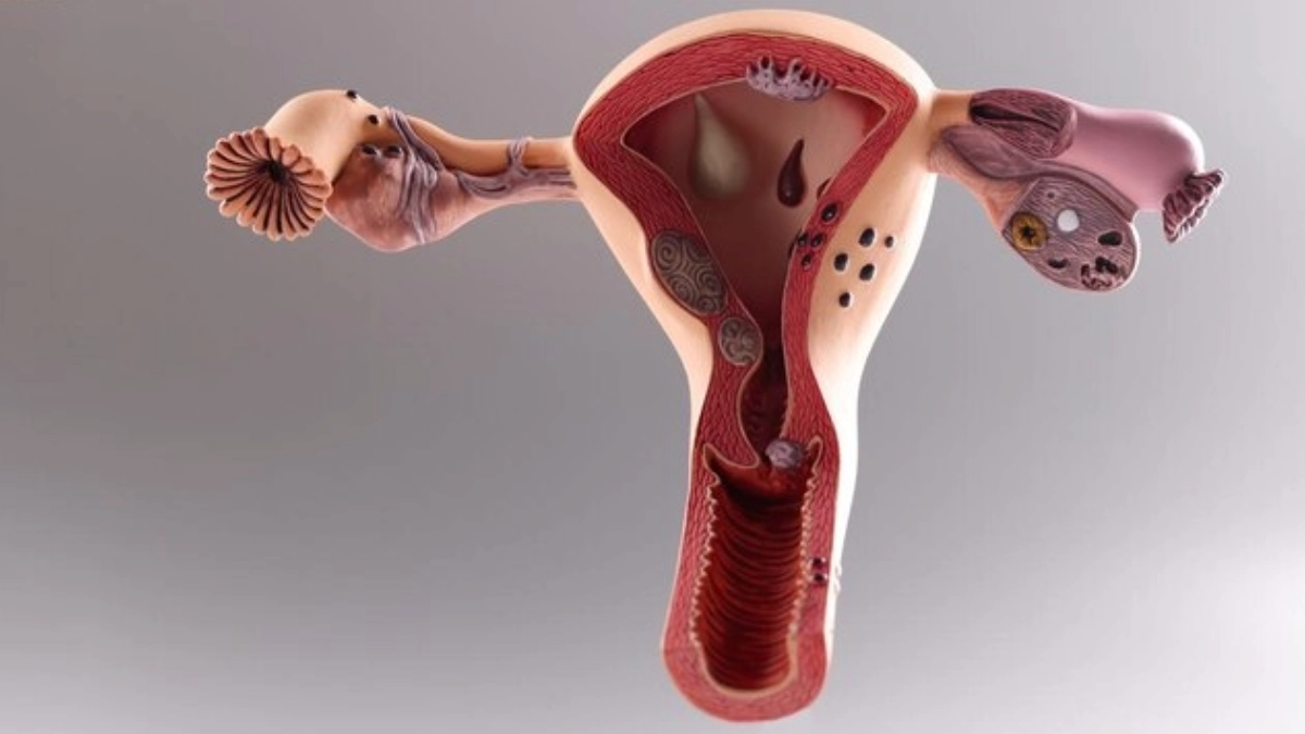 Cancerul uterin sau cancerul endometrial