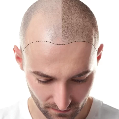 haartransplantation in der türkei