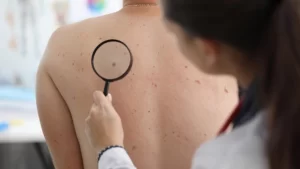 Skin Cancer Treatment in Turkey