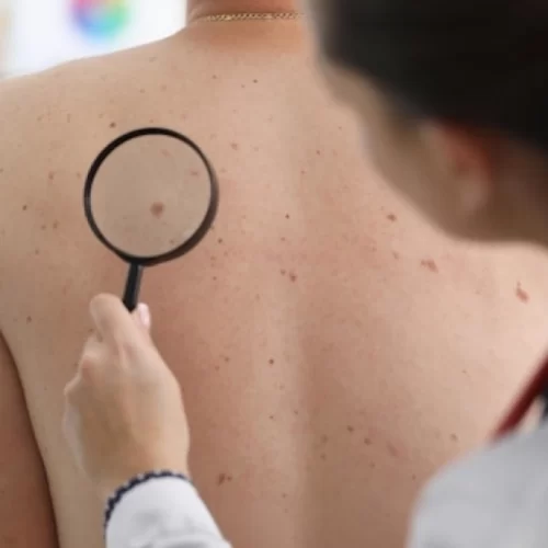 Skin Cancer Treatment in Turkey
