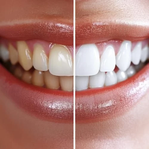Teeth Whitening in Turkey
