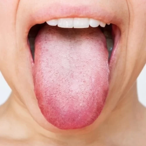 Tongue Cancer Treatment in Turkey