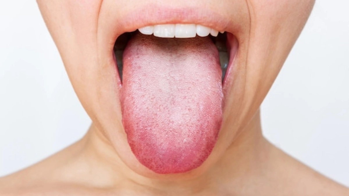 Tongue Cancer Treatment in Turkey