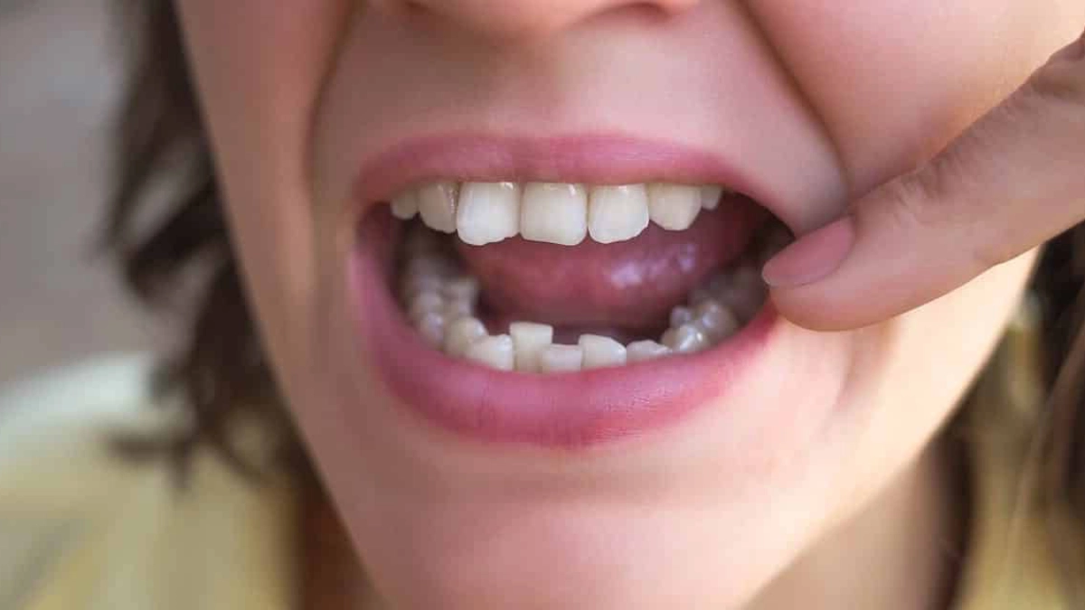 درمان کراودینگ دندان در ترکیه