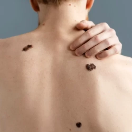 Skin Cancer