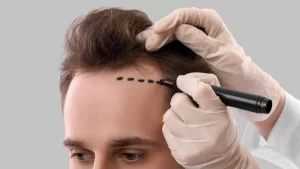 Wichtige Tipps nach einer Haartransplantation