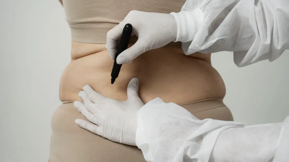 Türkiye'de Liposuction