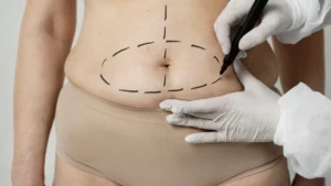 Liposuction