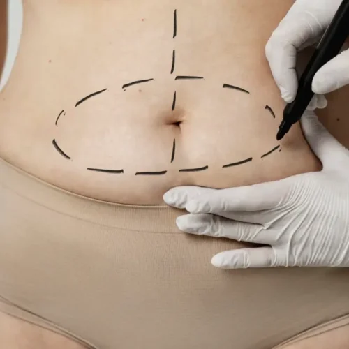 Liposuction