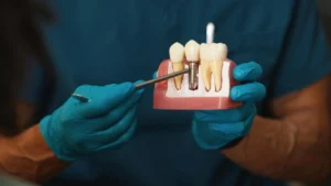 Implanturi dentare în Turcia