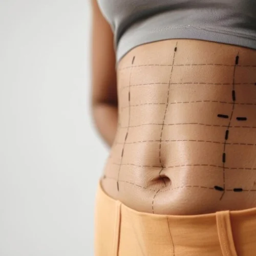 tummy-tuck-mituri-si-fapte Tummy Tuck Mituri şi. Fapte