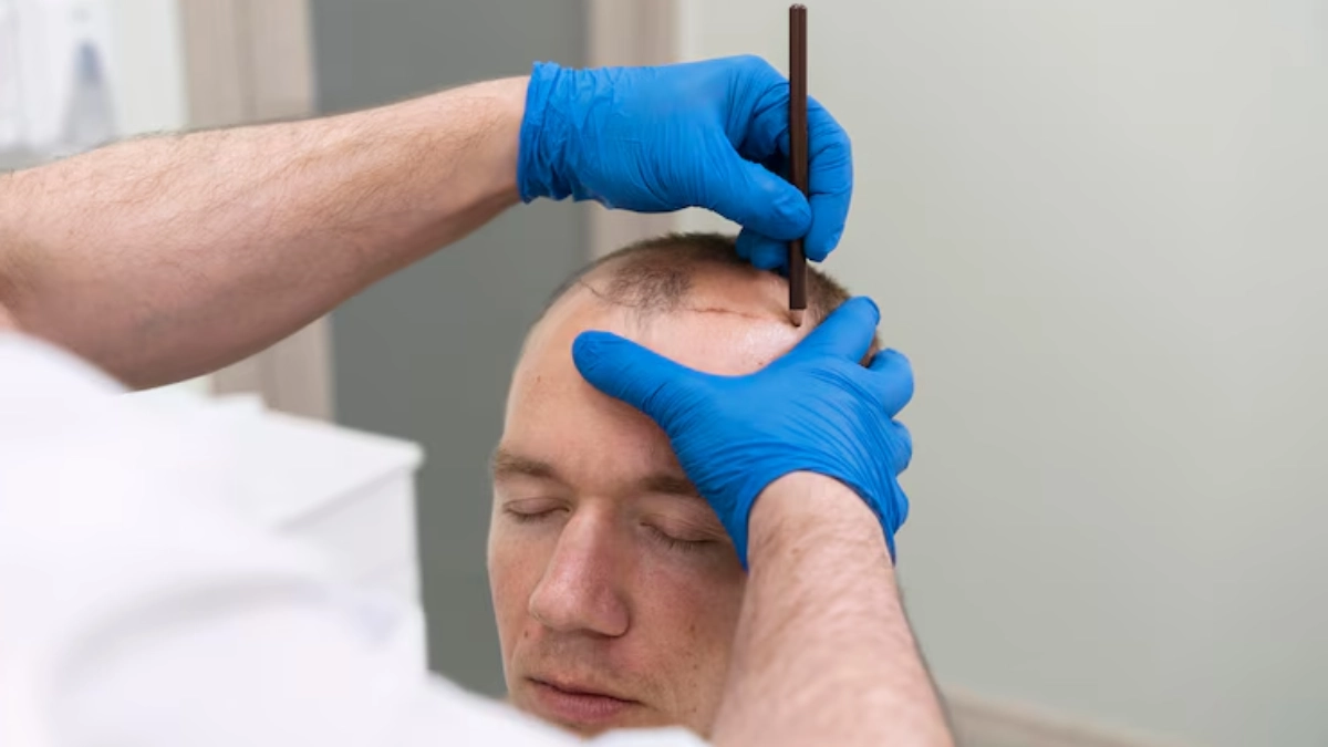 Wichtige Dinge, die Sie vor der Haartransplantation wissen sollten