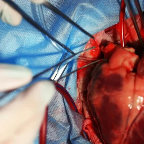 Open Heart Surgery in Turkey