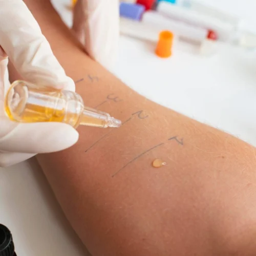 Allergy Testing in Turkey
