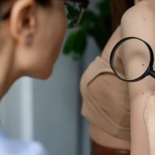 livedo-retikularis-nedir-belirtileri-nelerdir-g Livedo Retikülaris